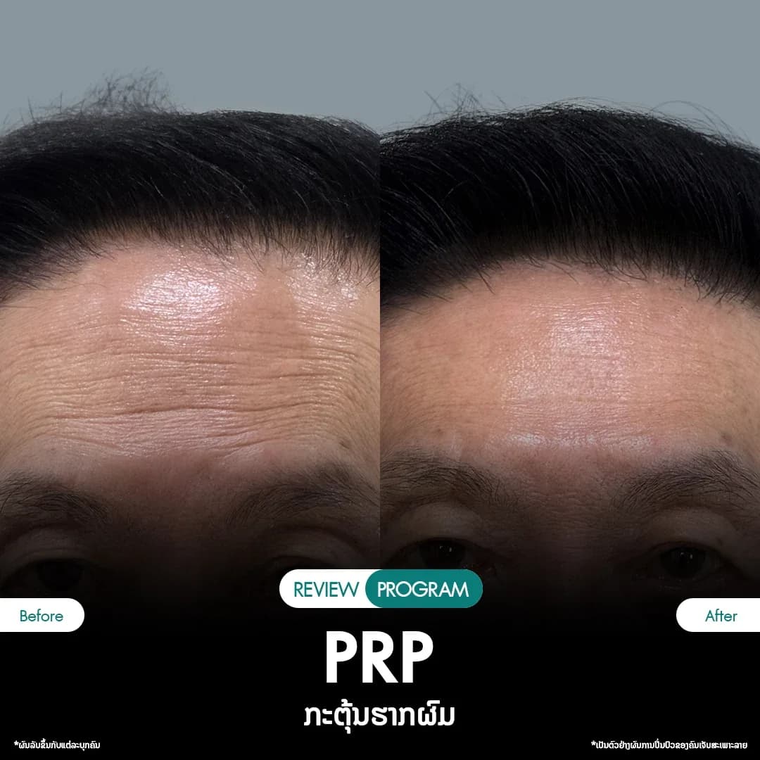 รีวิว ปลูกผม PRP 13