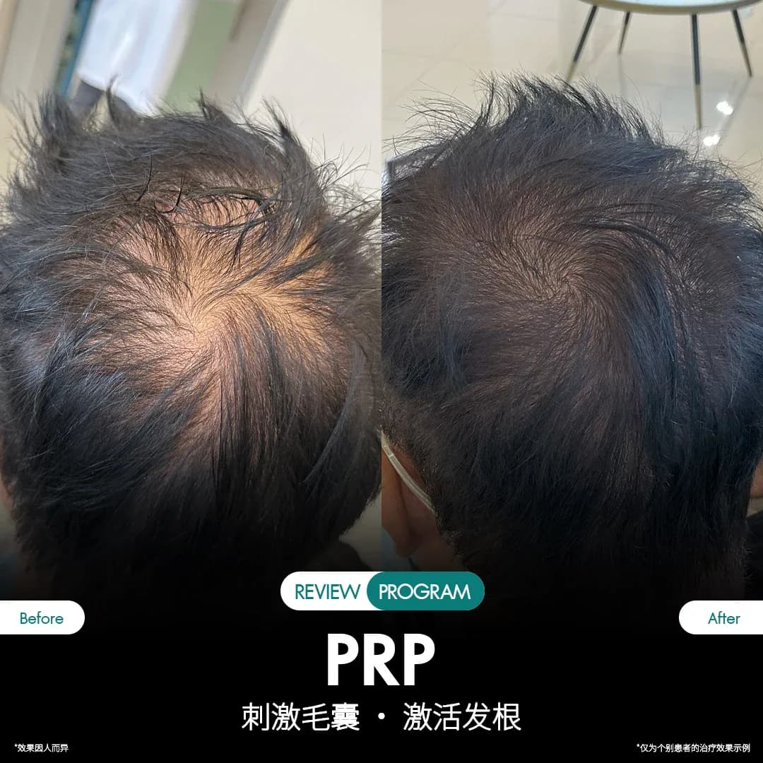 รีวิว ปลูกผม PRP 14