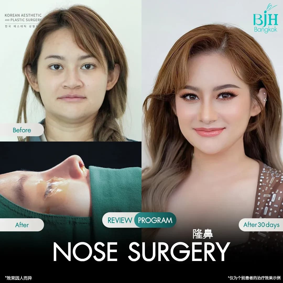 รีวิวเสริมจมูก 1