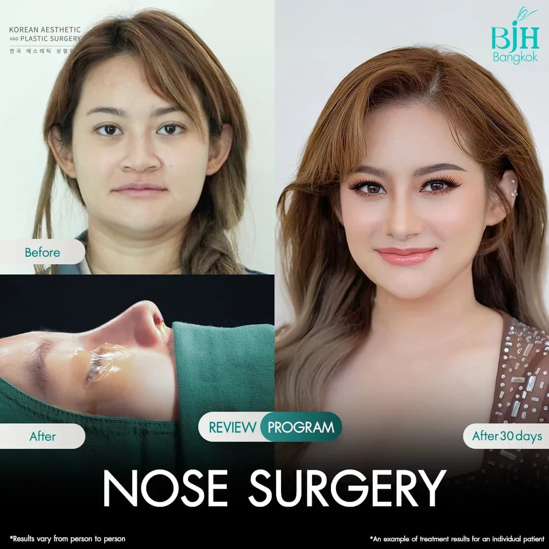 รีวิวเสริมจมูก 1