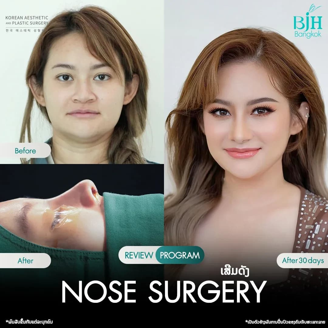 รีวิวเสริมจมูก 1