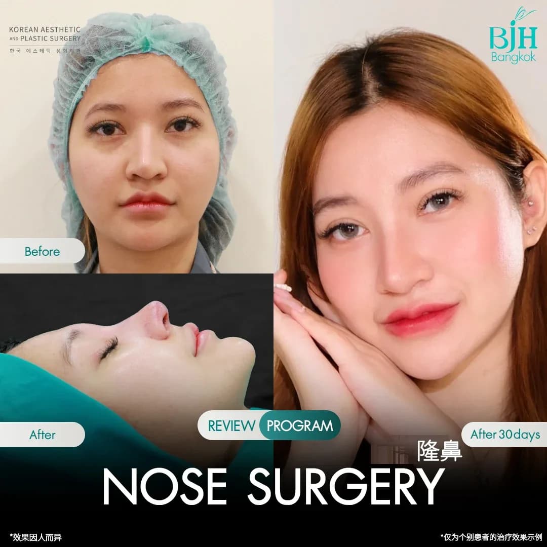รีวิวเสริมจมูก 3