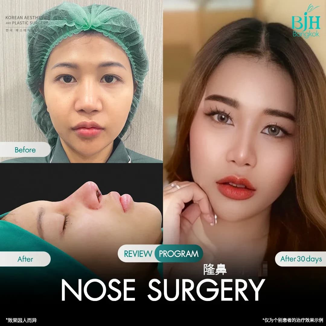 รีวิวเสริมจมูก 4