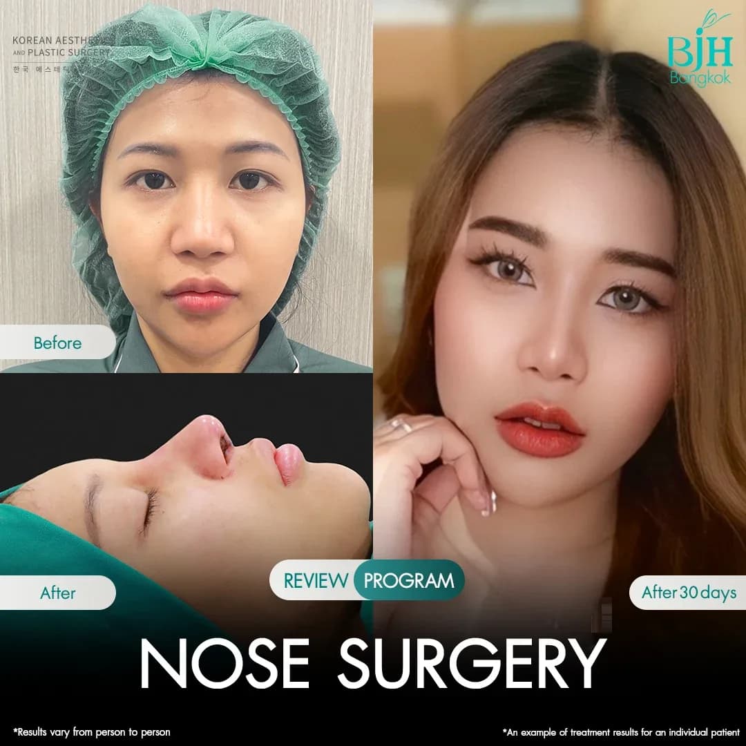 รีวิวเสริมจมูก 4