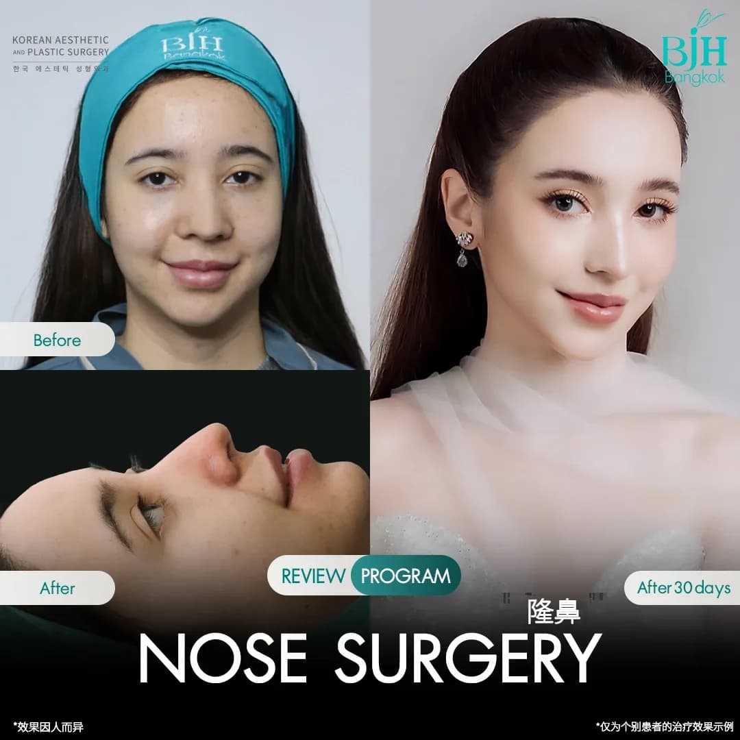รีวิวเสริมจมูก 5
