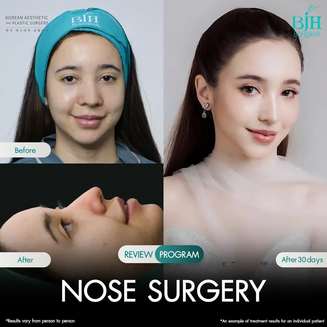 รีวิวเสริมจมูก 5