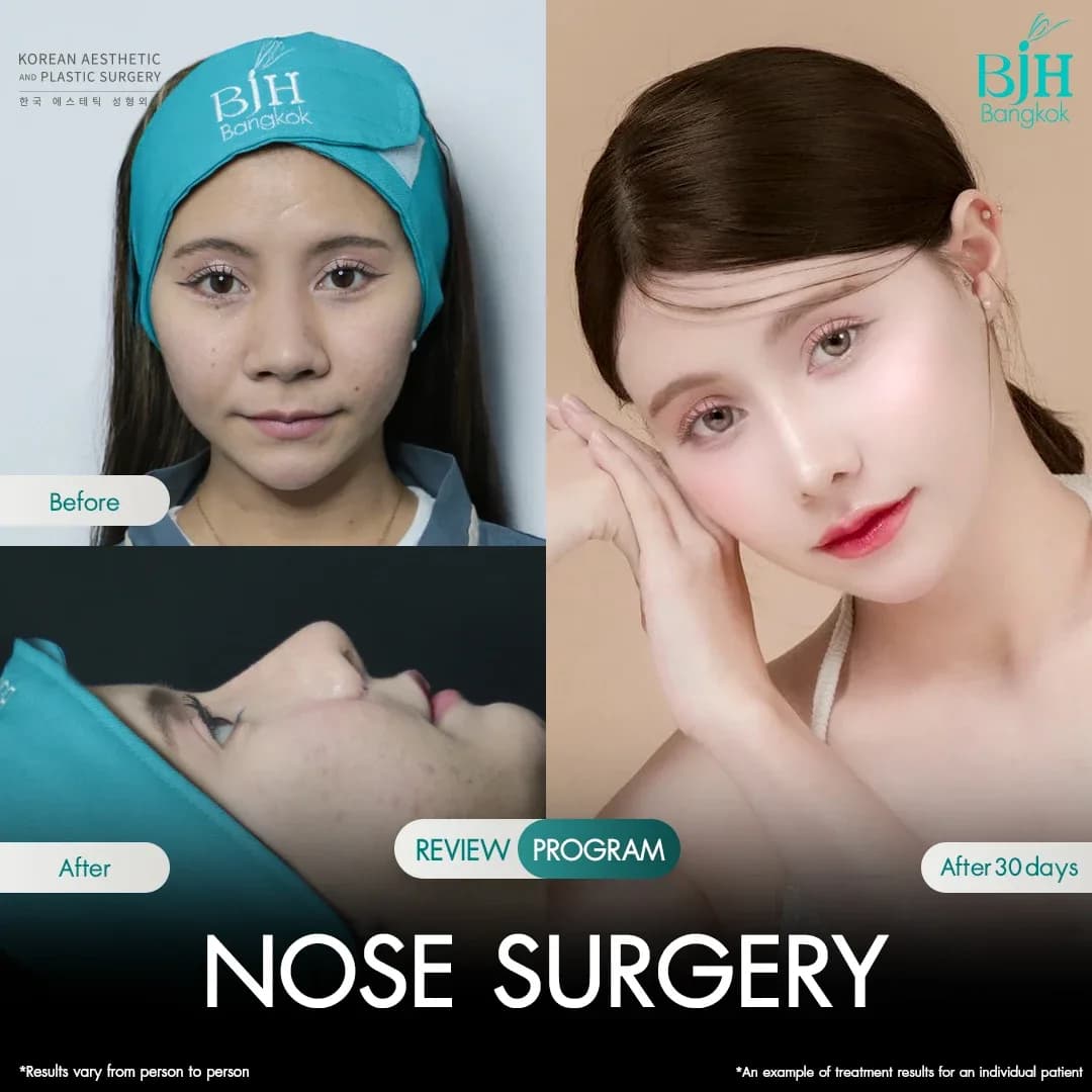 รีวิวเสริมจมูก 6