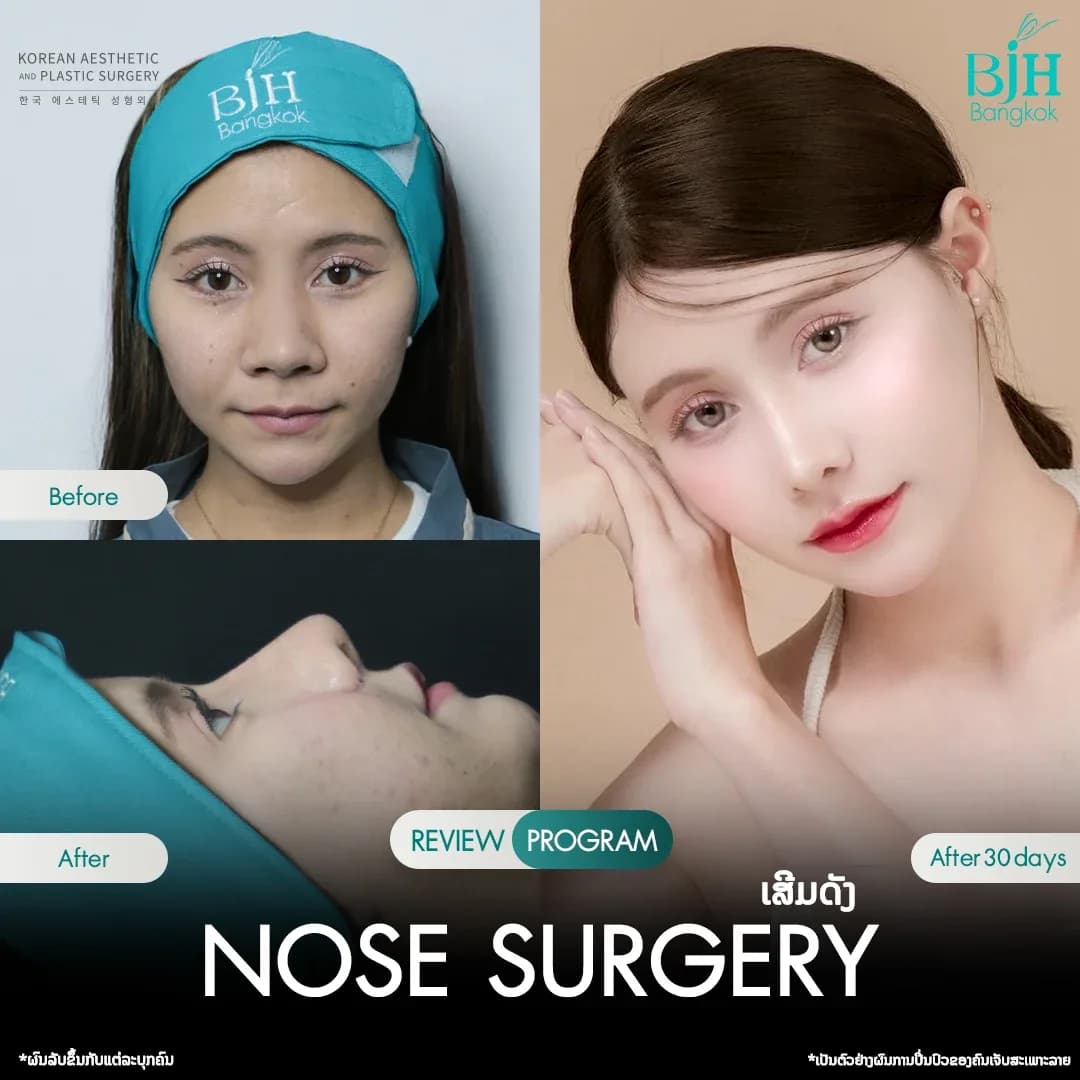 รีวิวเสริมจมูก 6