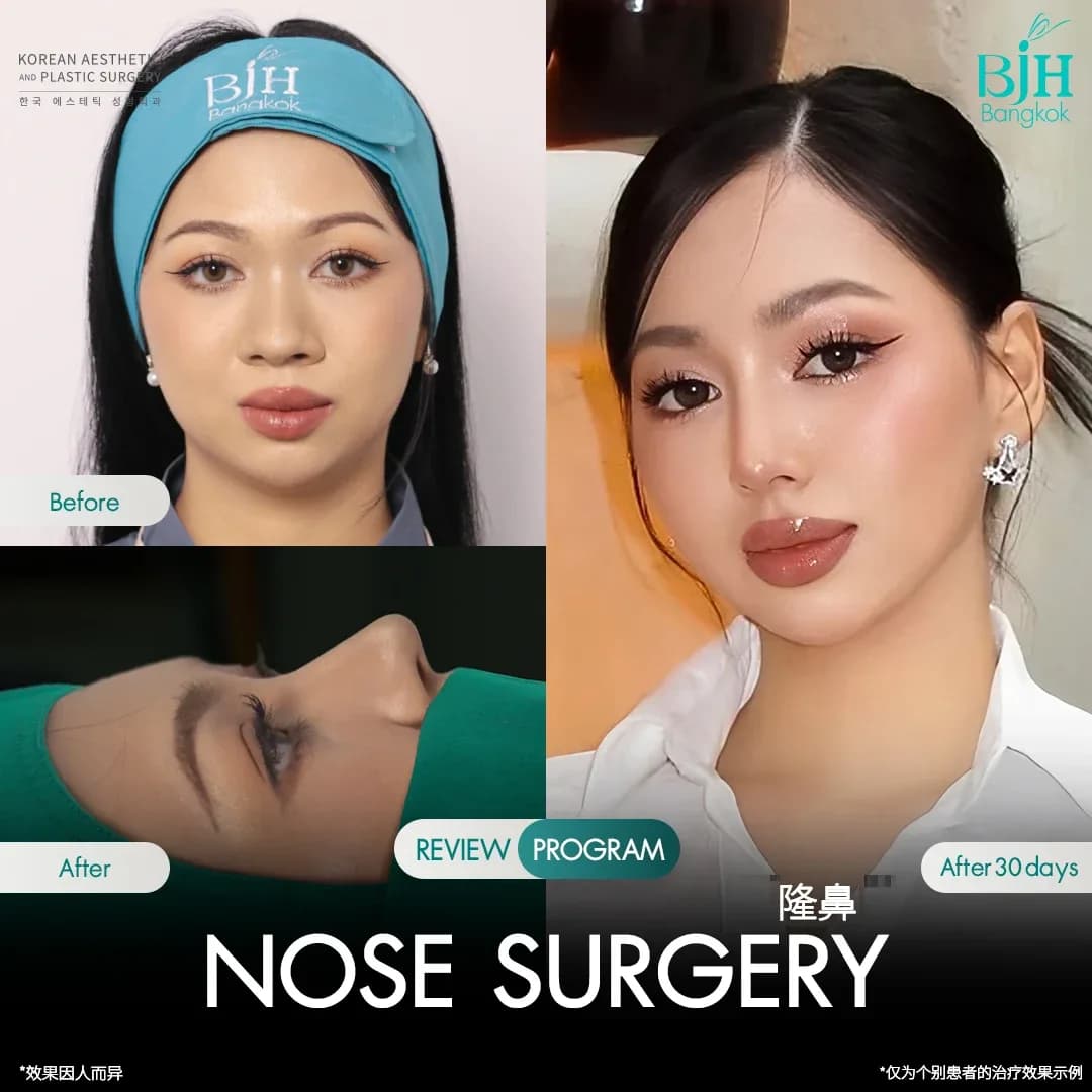 รีวิวเสริมจมูก 7