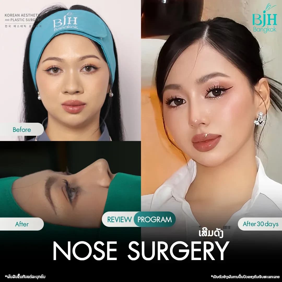 รีวิวเสริมจมูก 7