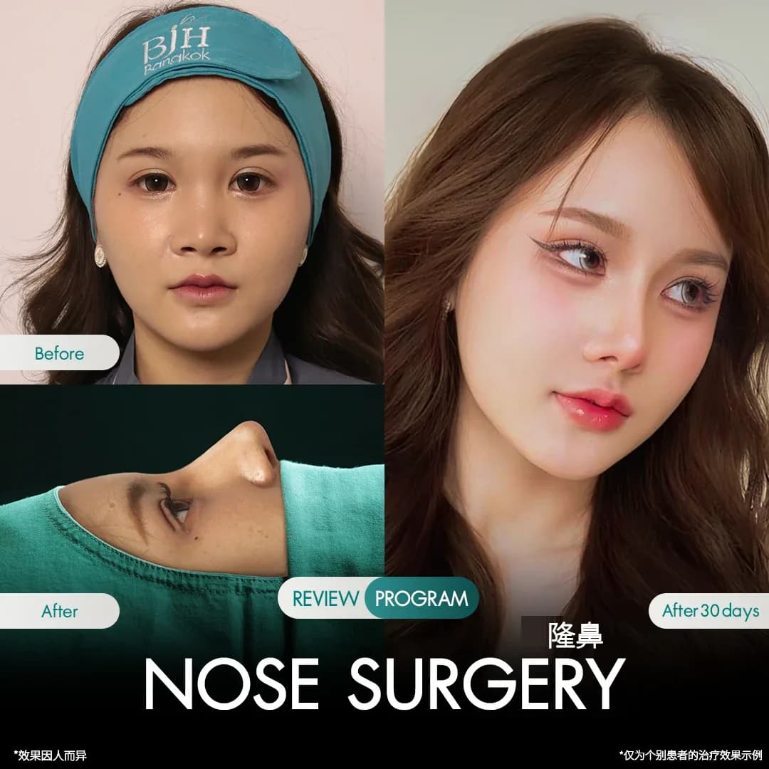 รีวิวเสริมจมูก 8