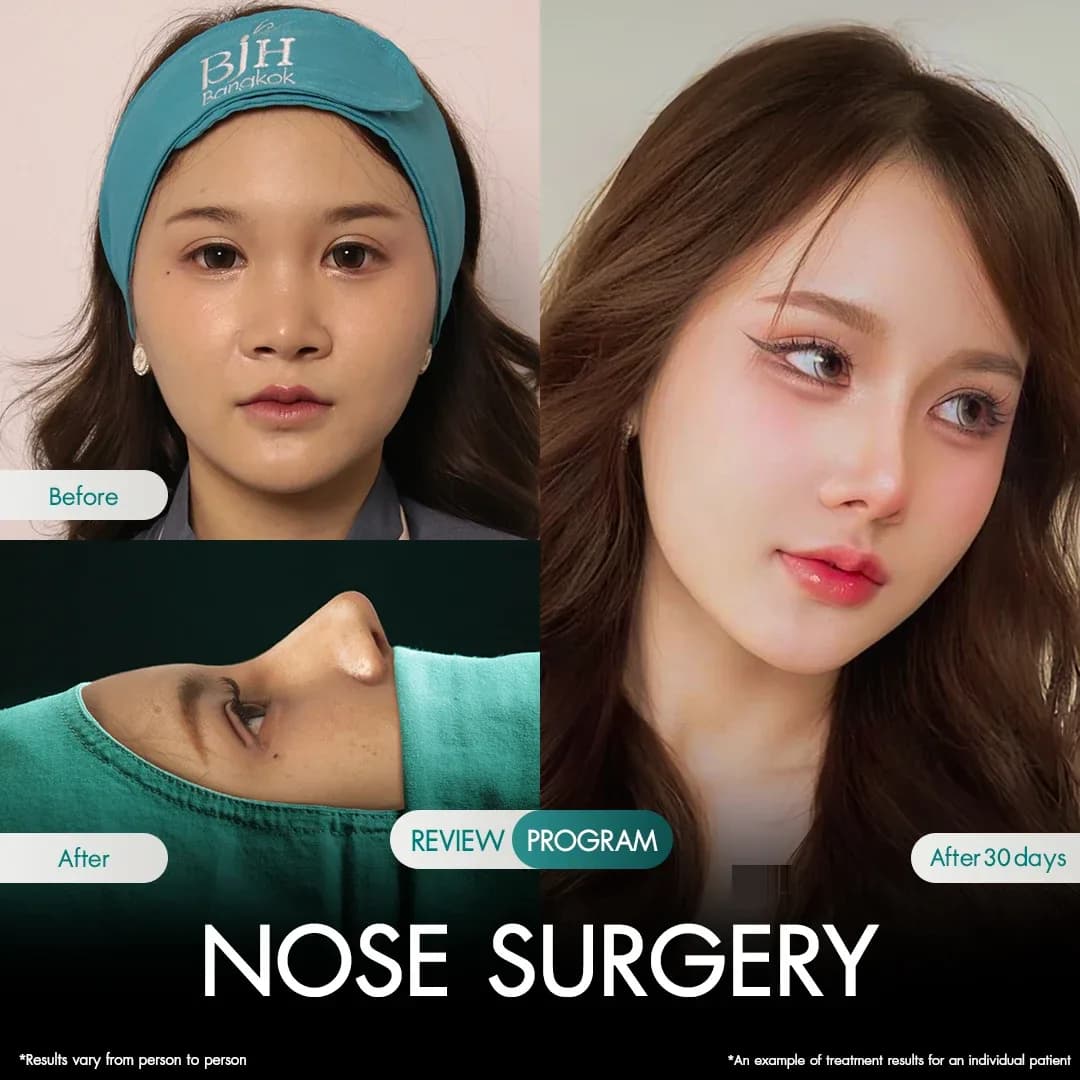 รีวิวเสริมจมูก 8