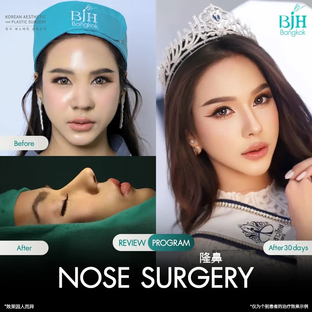 รีวิวเสริมจมูก 9