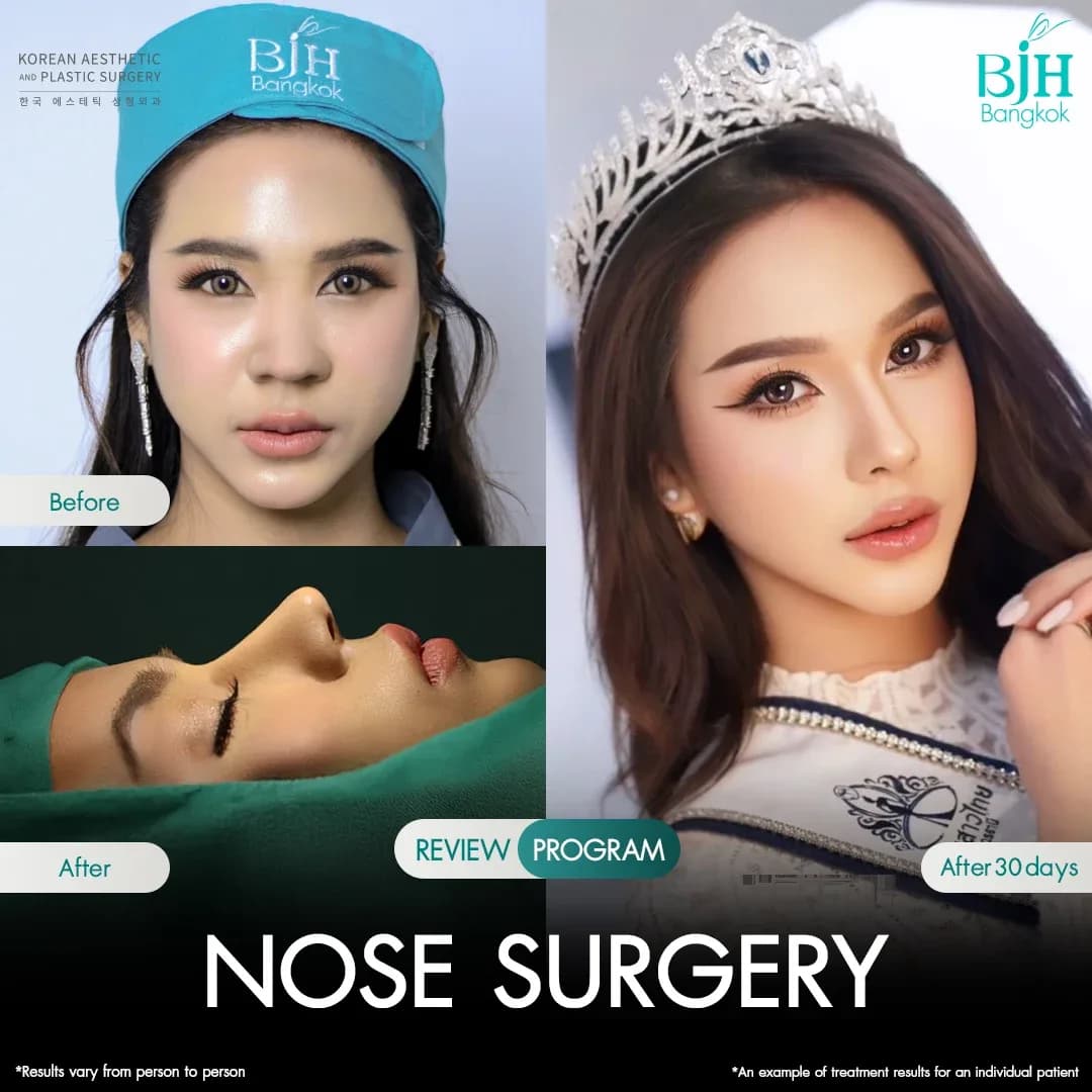 รีวิวเสริมจมูก 9