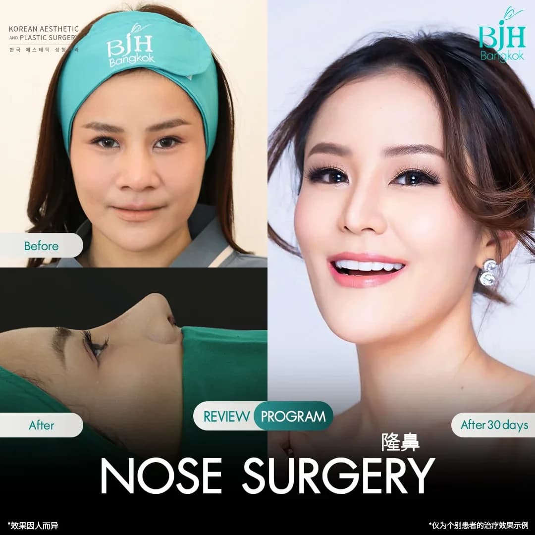 รีวิวเสริมจมูก 10