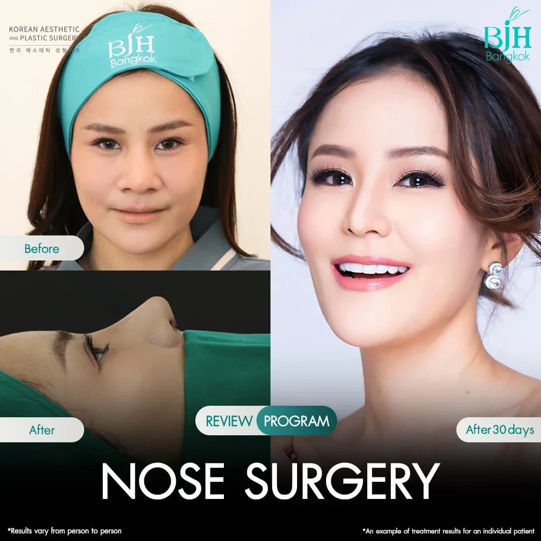 รีวิวเสริมจมูก 10