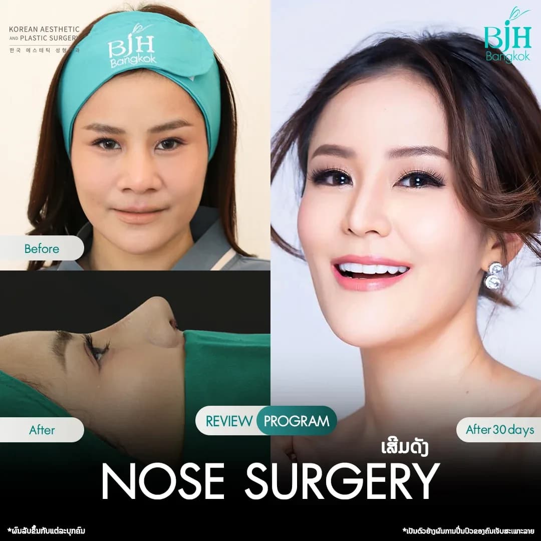 รีวิวเสริมจมูก 10