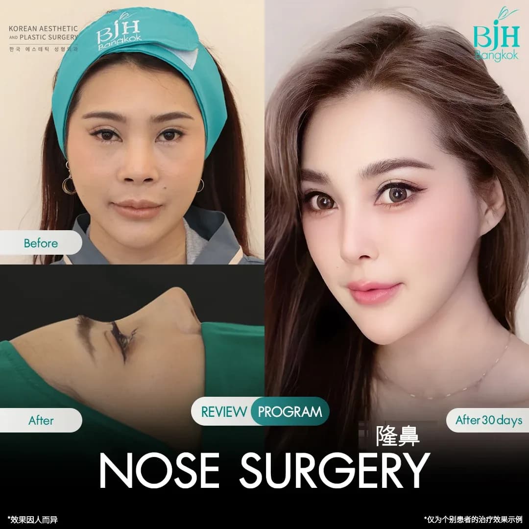 รีวิวเสริมจมูก 11