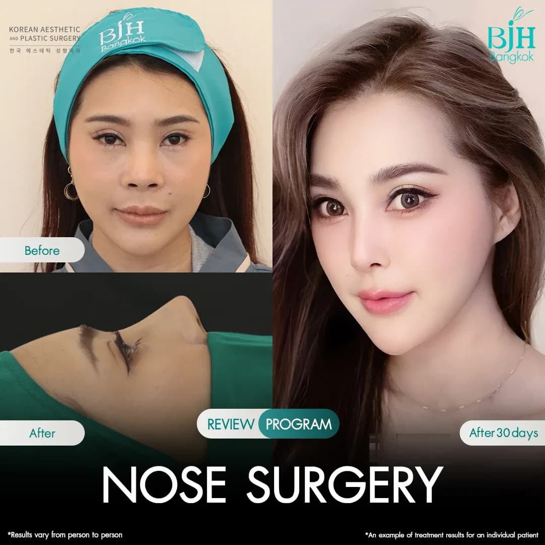 รีวิวเสริมจมูก 11