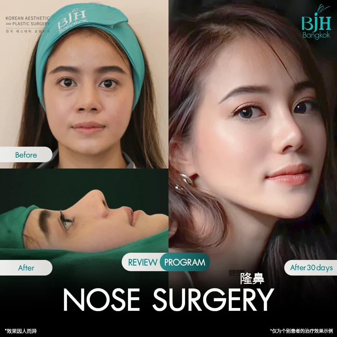 รีวิวเสริมจมูก 12