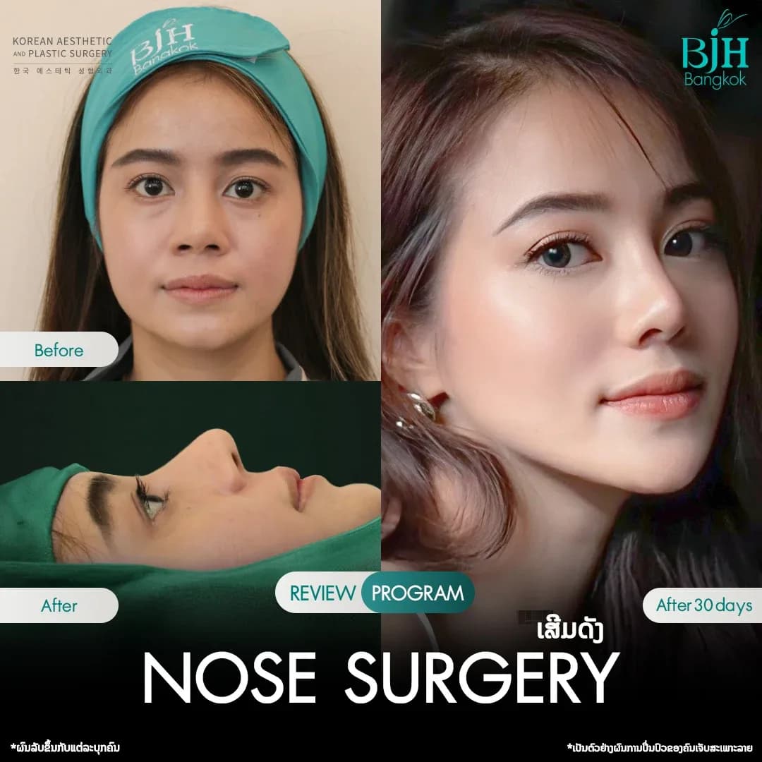 รีวิวเสริมจมูก 12