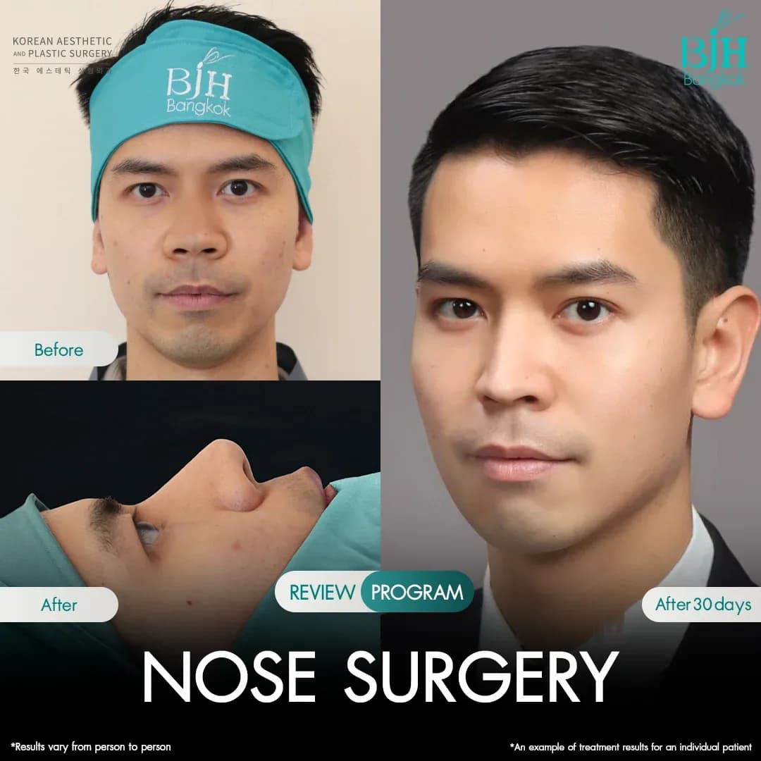 รีวิวเสริมจมูก 13