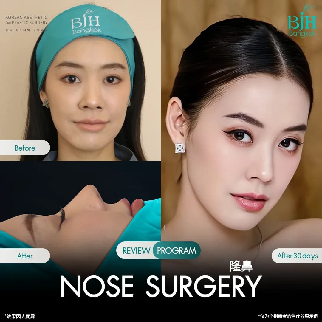 รีวิวเสริมจมูก 14