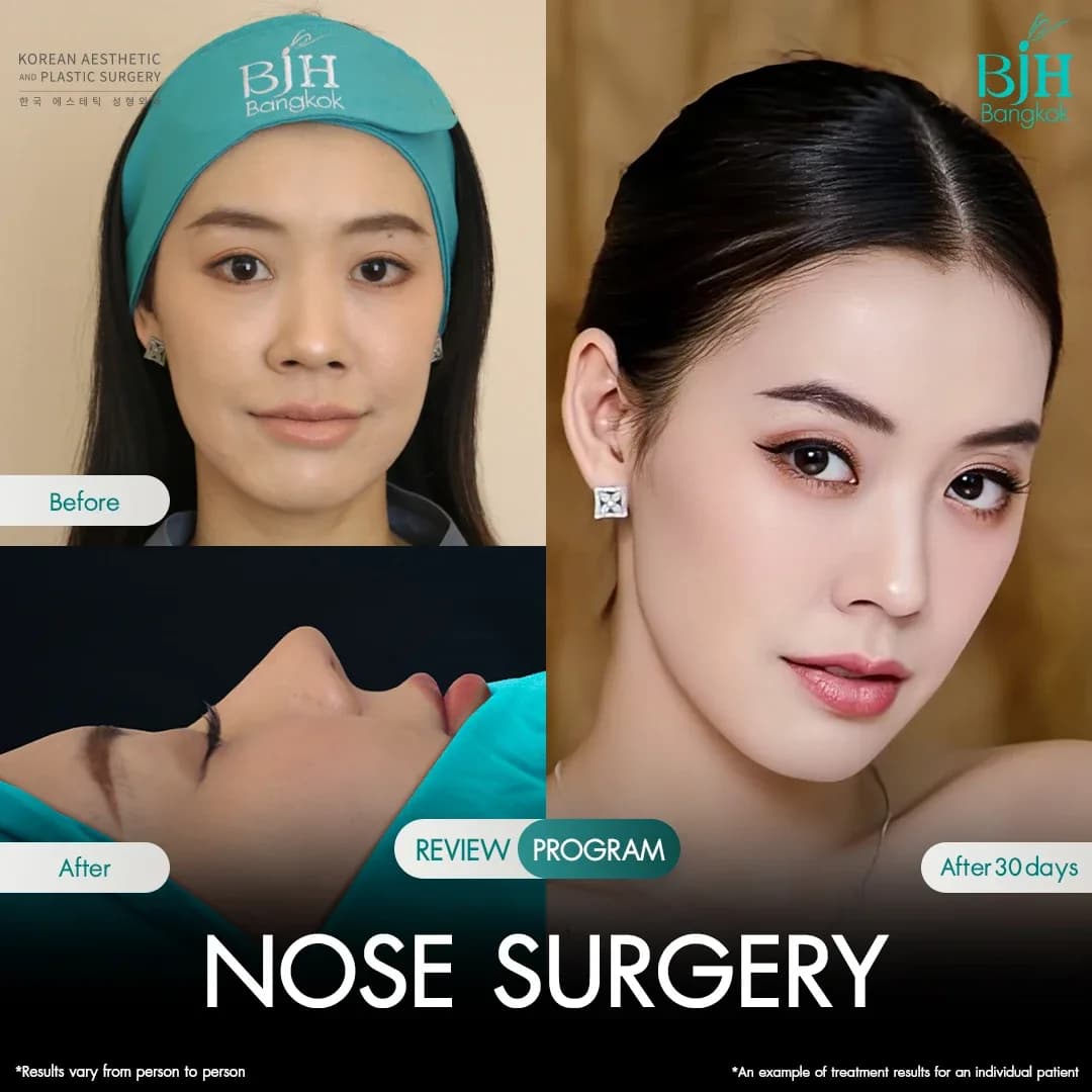 รีวิวเสริมจมูก 14