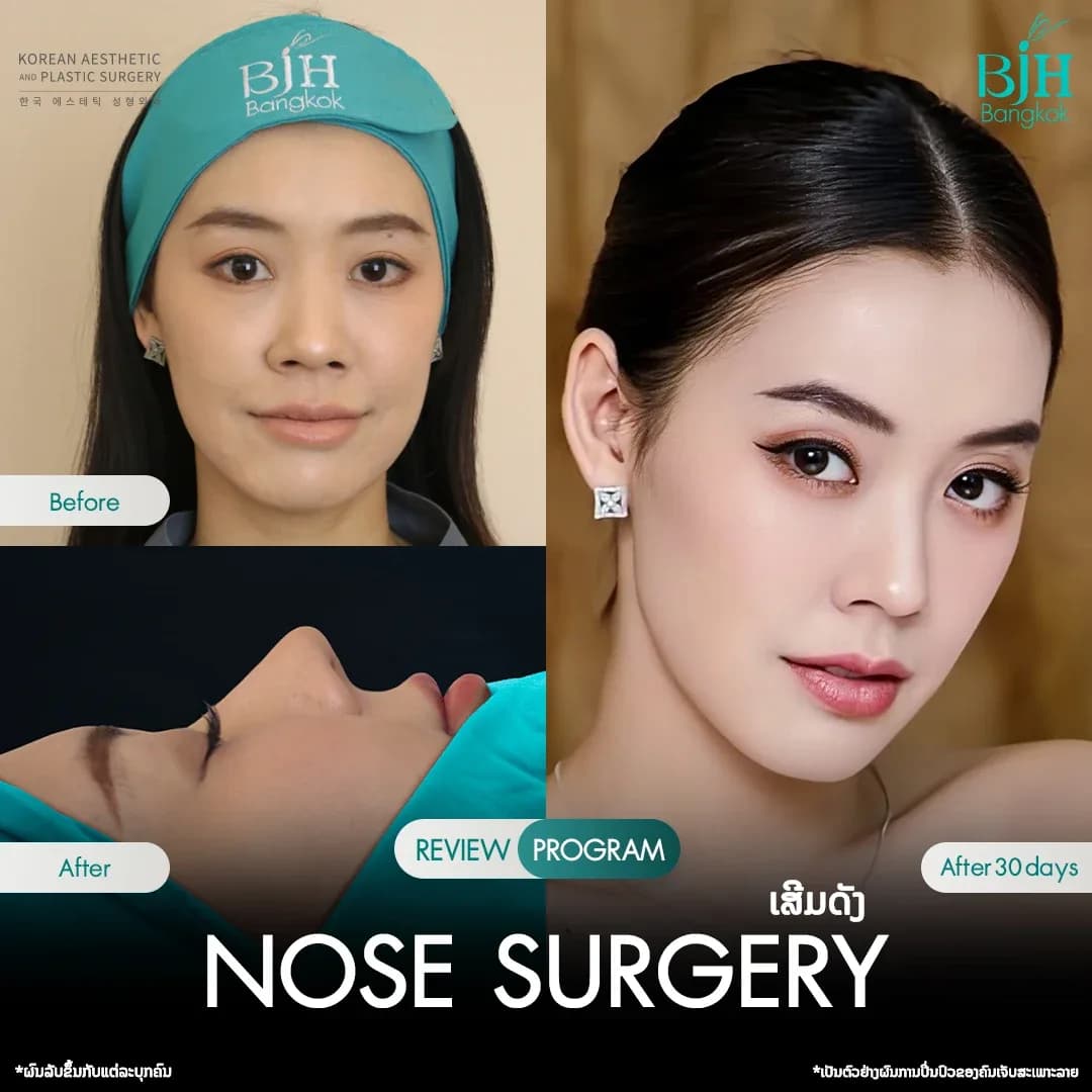 รีวิวเสริมจมูก 14