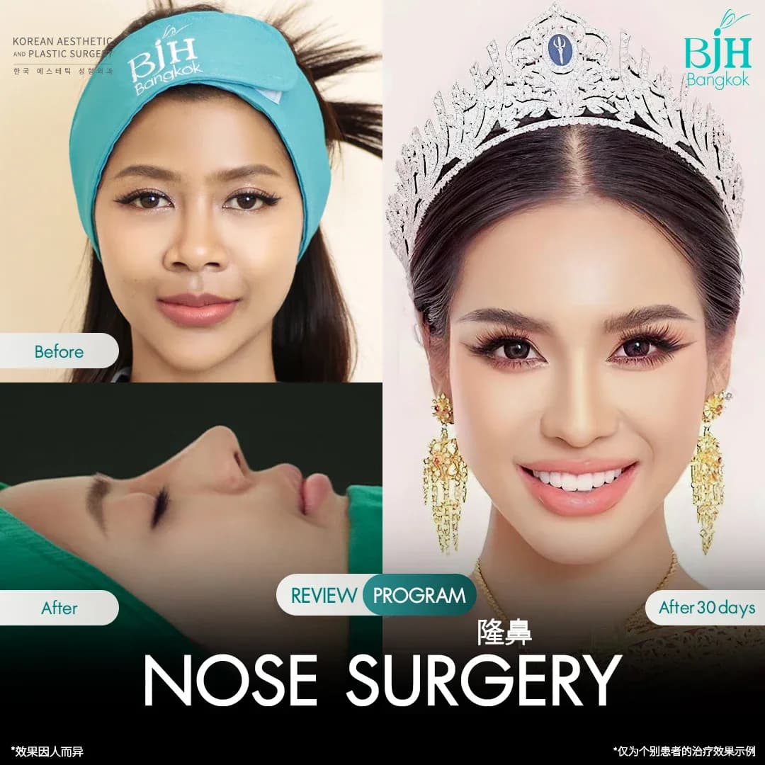 รีวิวเสริมจมูก 15