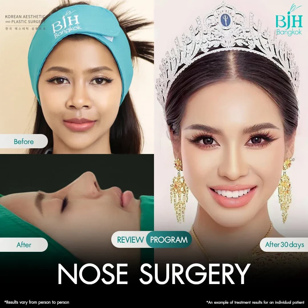 รีวิวเสริมจมูก 15
