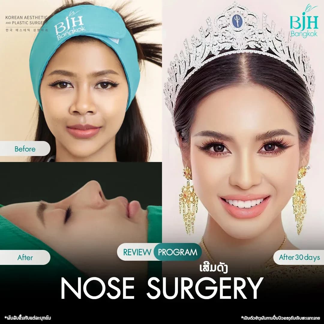 รีวิวเสริมจมูก 15