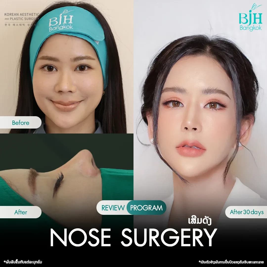 รีวิวเสริมจมูก 16