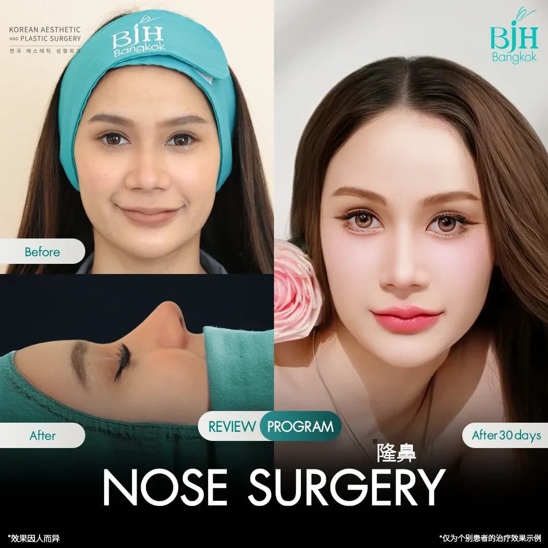 รีวิวเสริมจมูก 17