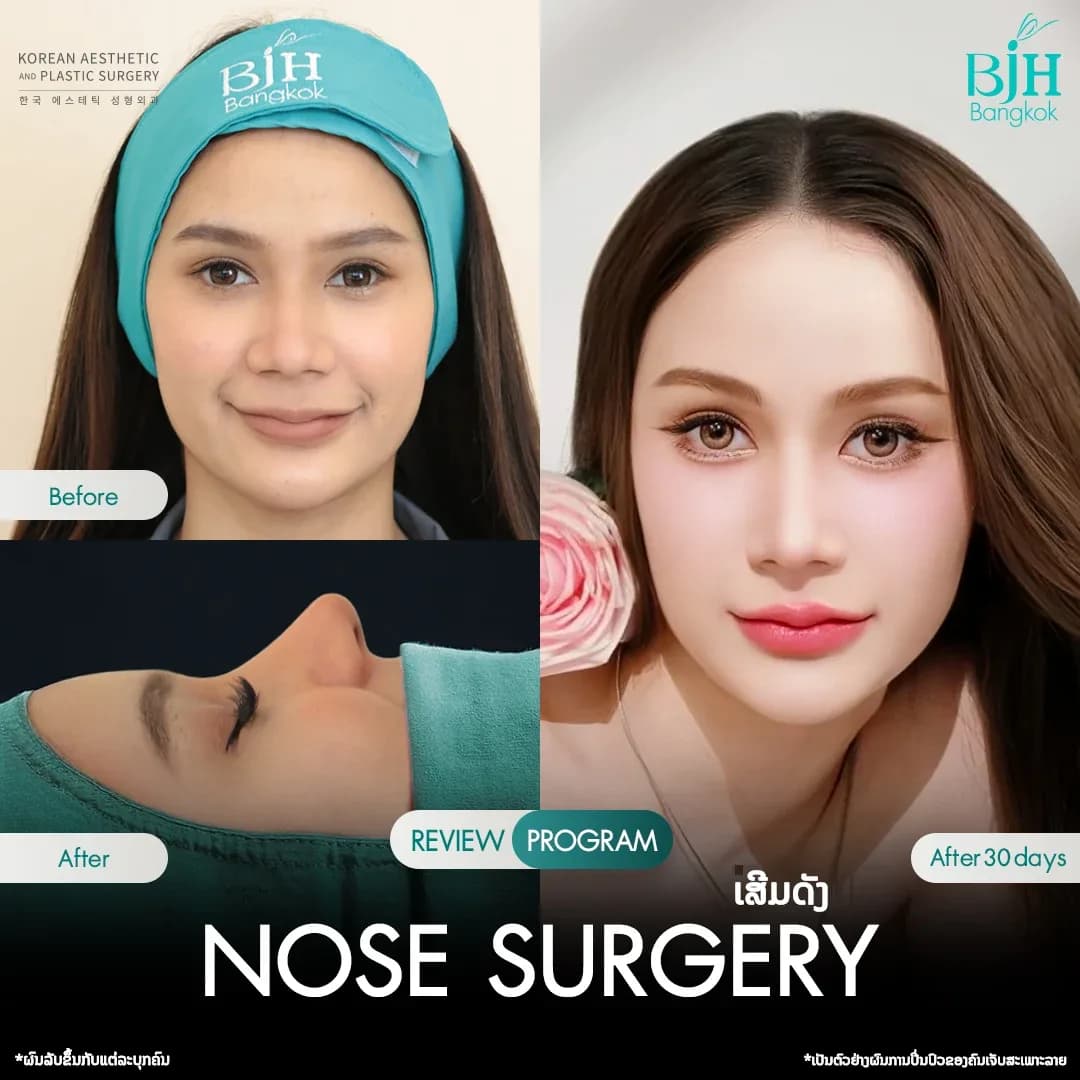 รีวิวเสริมจมูก 17
