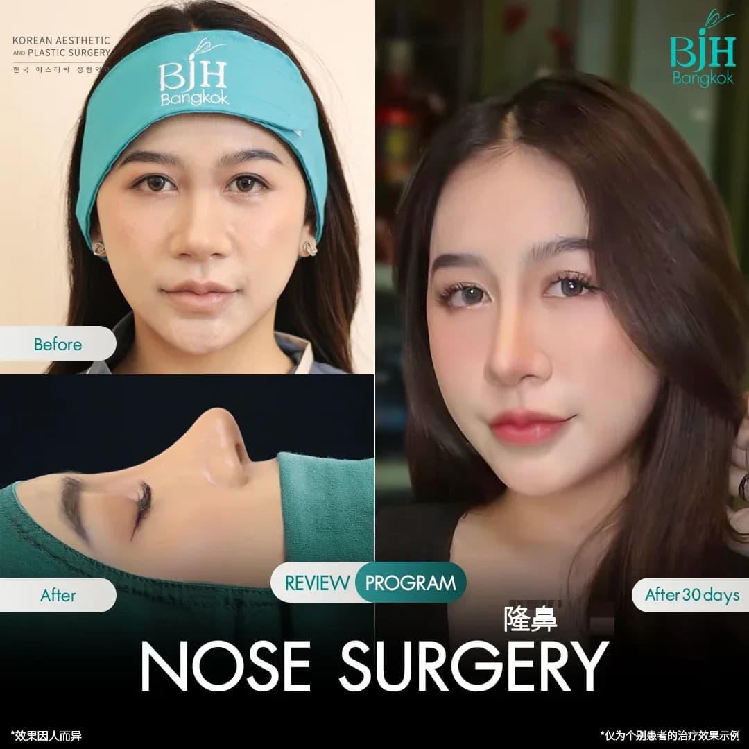 รีวิวเสริมจมูก 18