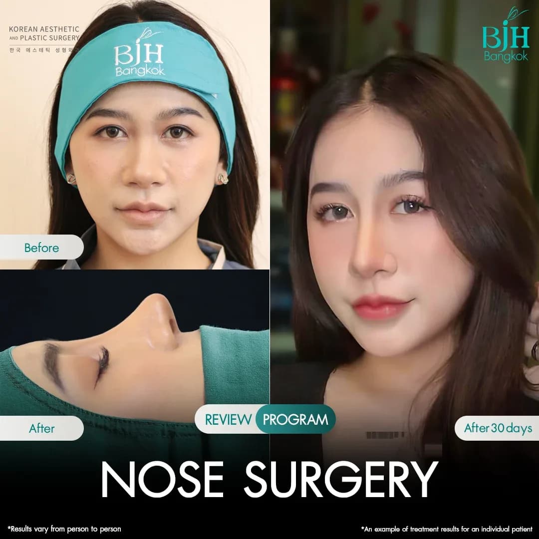 รีวิวเสริมจมูก 18