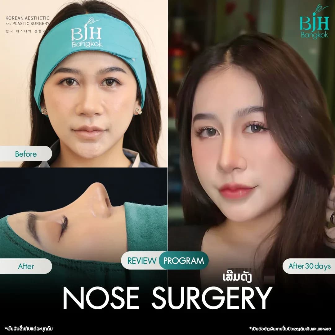 รีวิวเสริมจมูก 18