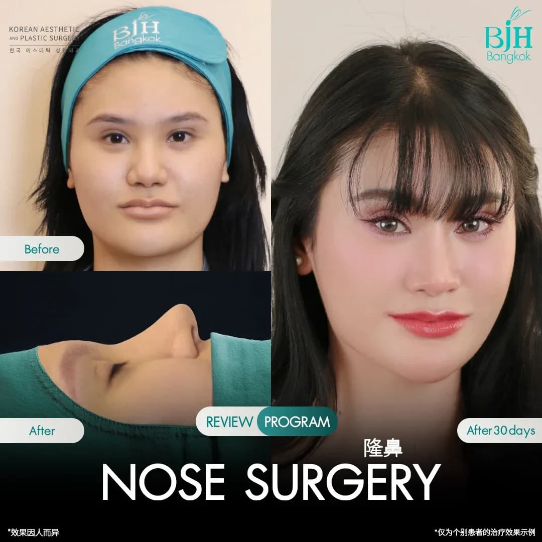 รีวิวเสริมจมูก 19