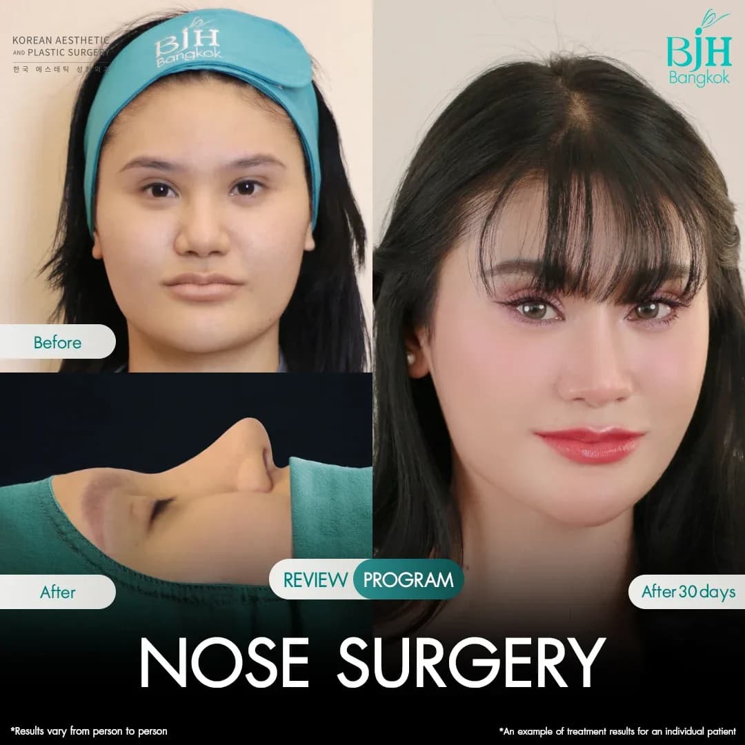 รีวิวเสริมจมูก 19