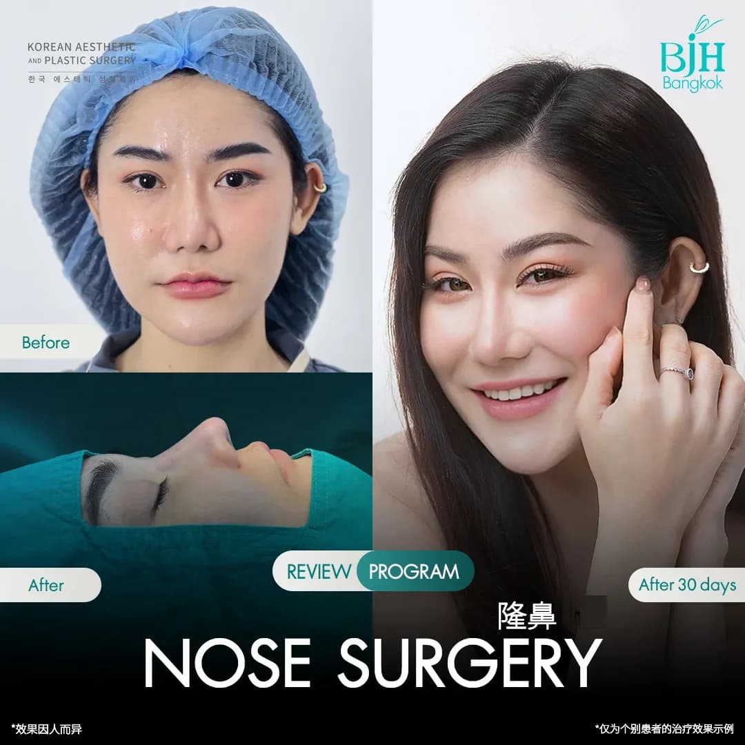 รีวิวเสริมจมูก 20