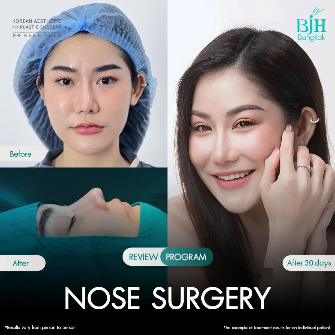 รีวิวเสริมจมูก 20