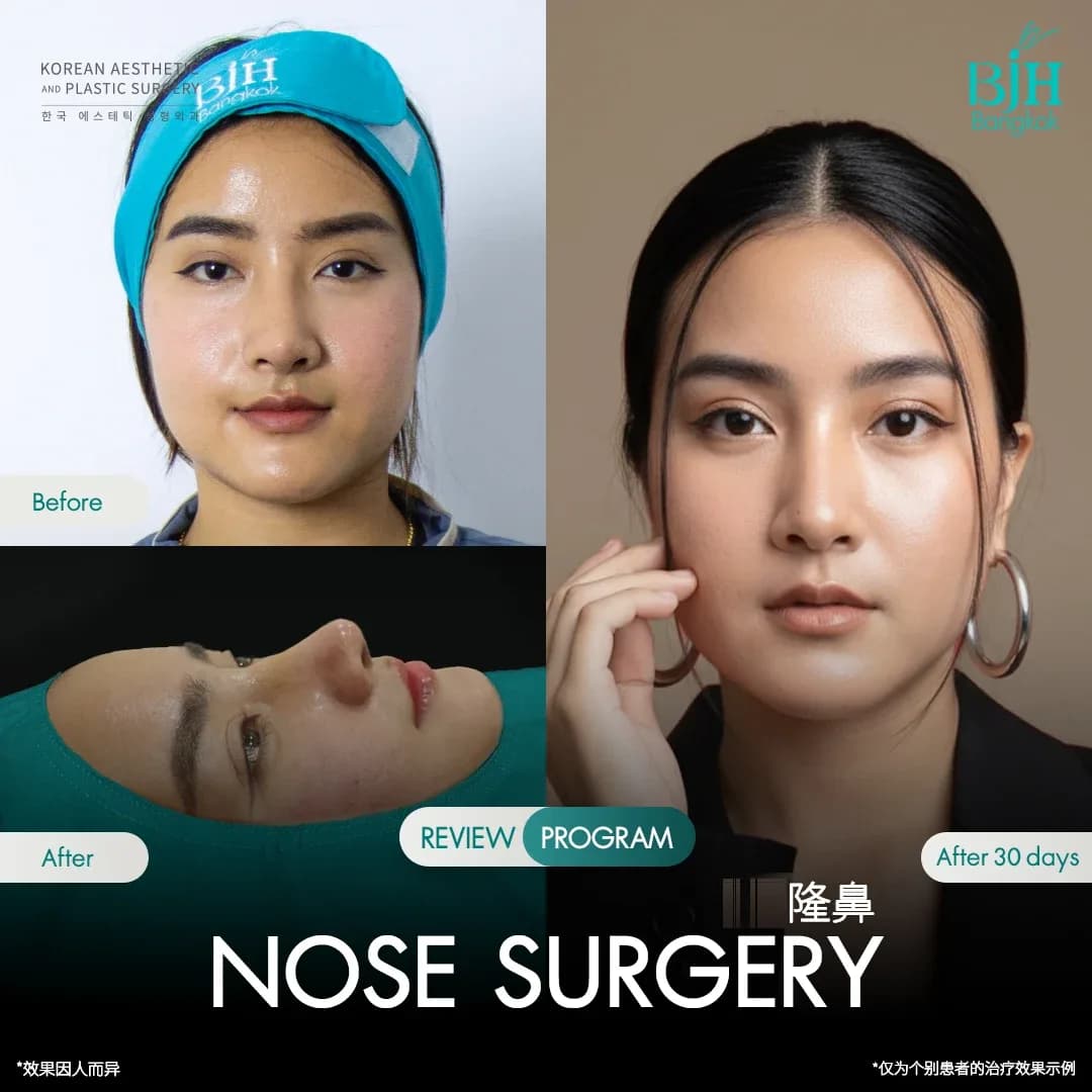 รีวิวเสริมจมูก 21