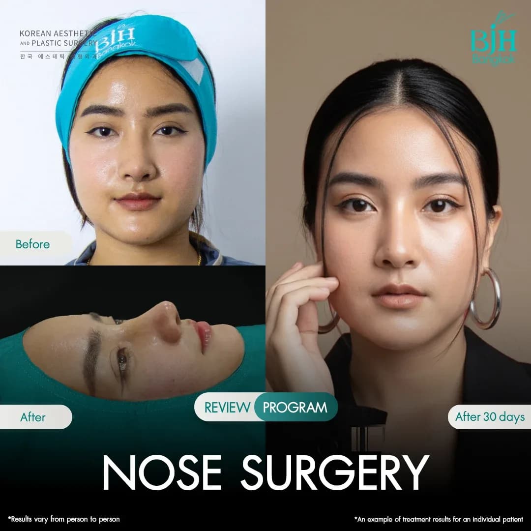 รีวิวเสริมจมูก 21