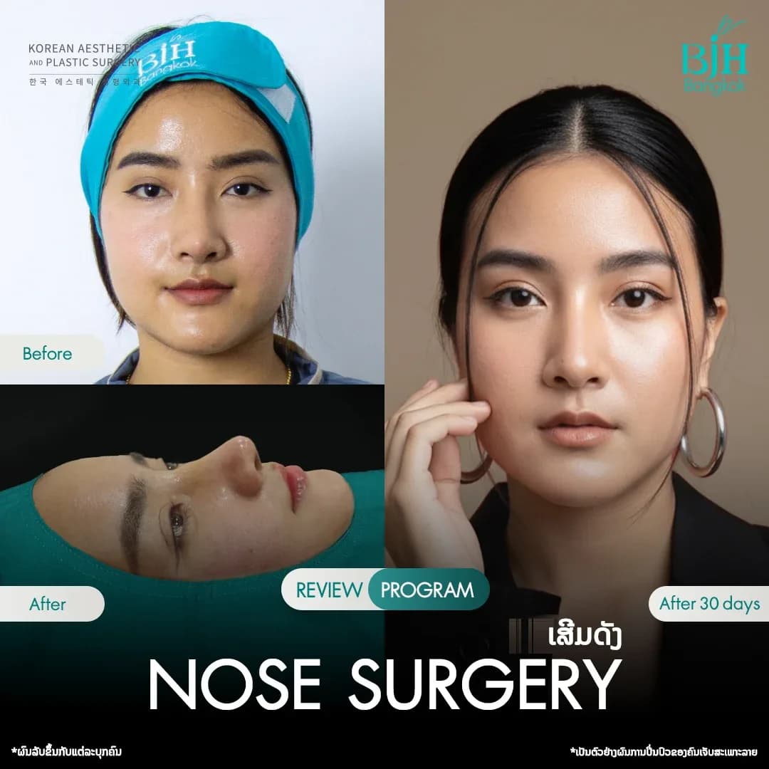 รีวิวเสริมจมูก 21