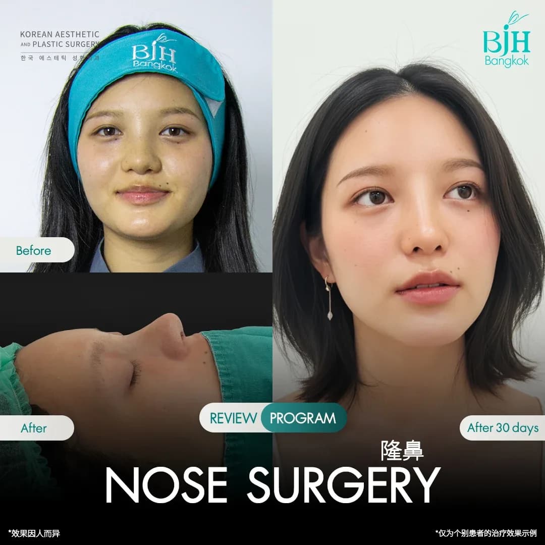 รีวิวเสริมจมูก 22