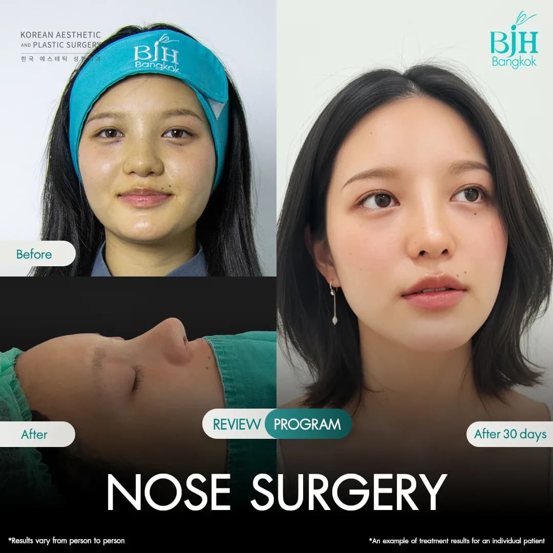 รีวิวเสริมจมูก 22