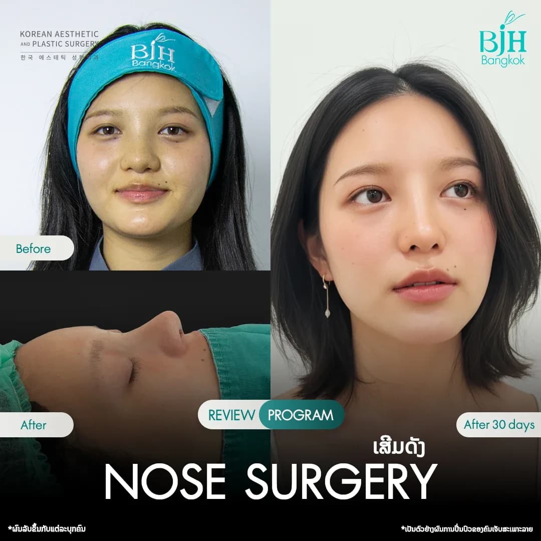 รีวิวเสริมจมูก 22