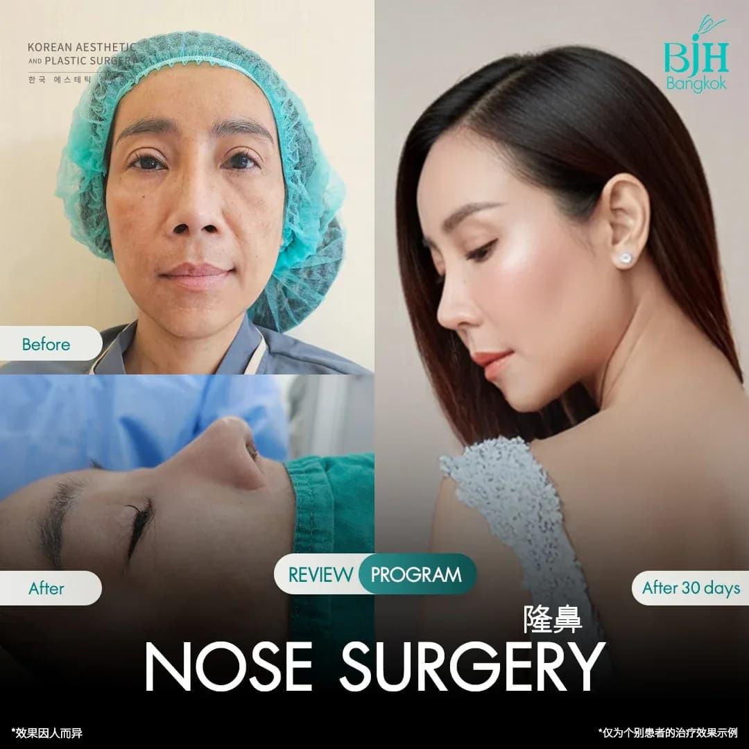 รีวิวเสริมจมูก 23