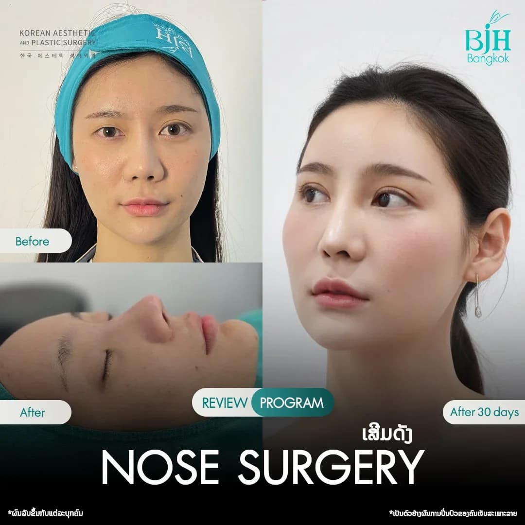 รีวิวเสริมจมูก 24